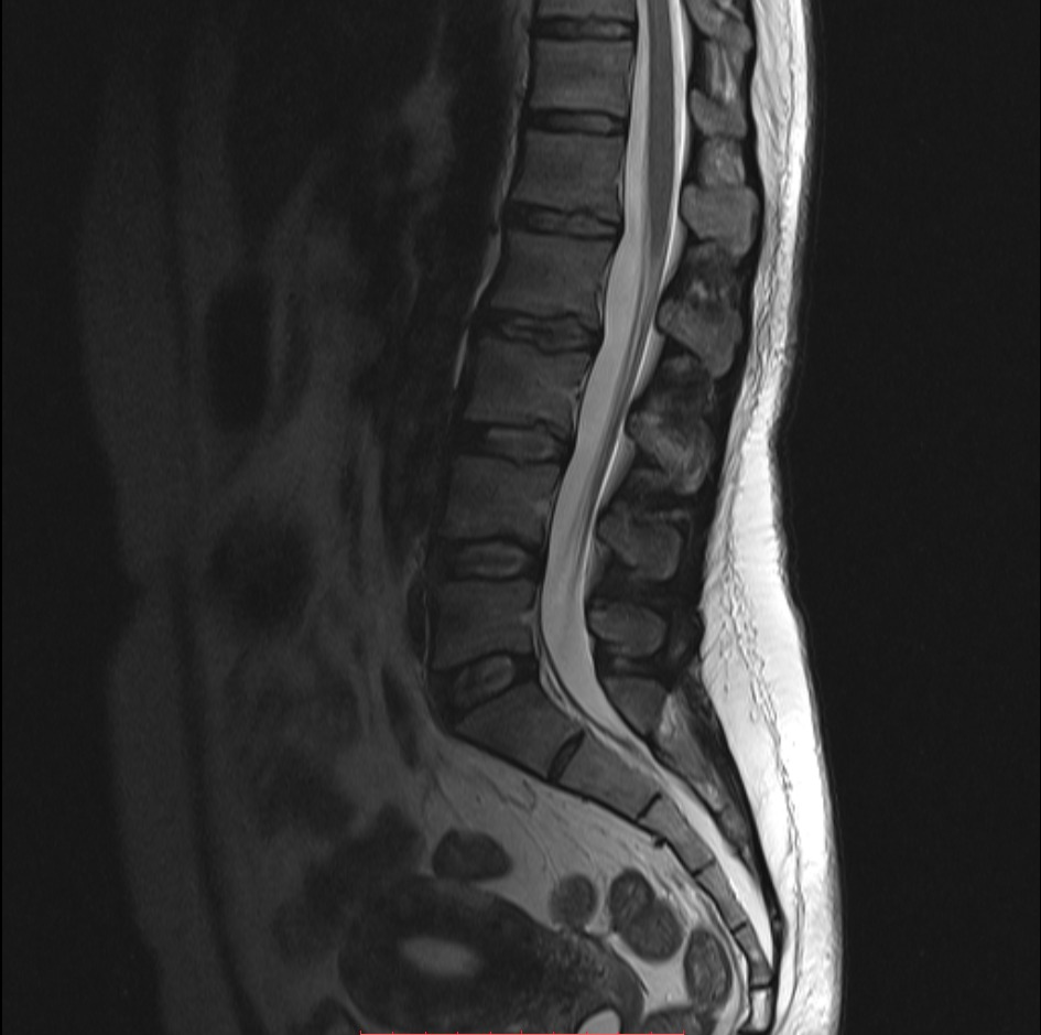 МРТ пояснично-крестцового отдела позвоночника