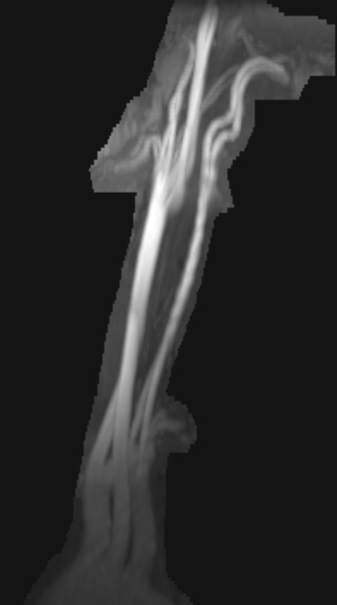 МРТ сосудов шеи