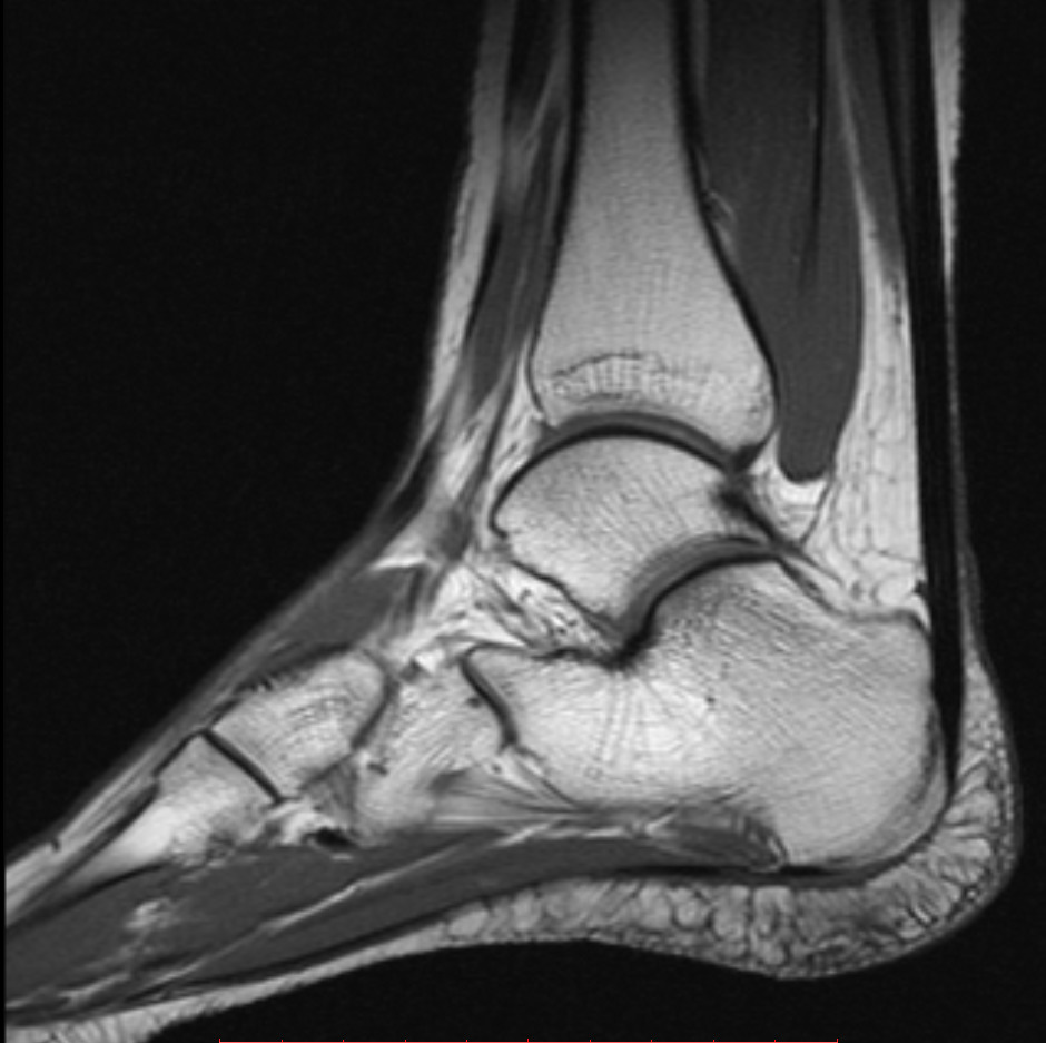 МРТ голеностопного сустава