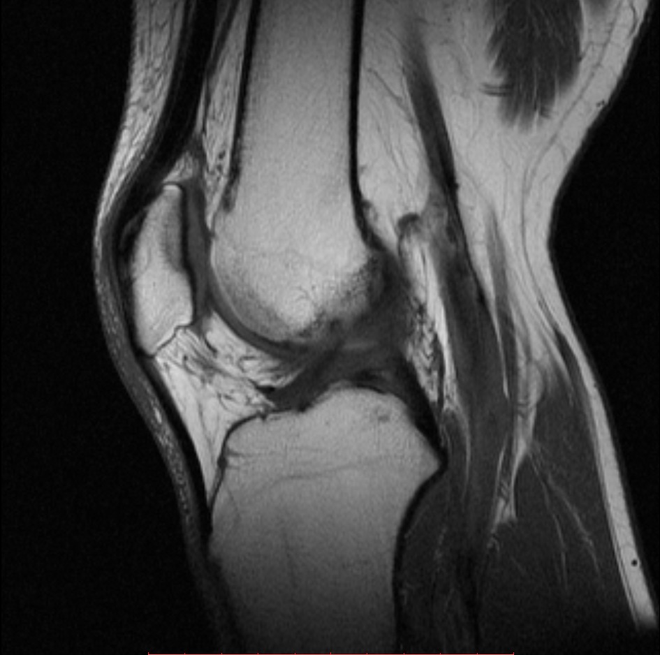 МРТ коленного сустава