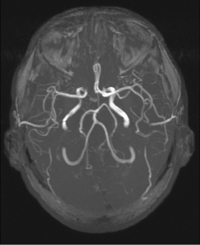 МРТ сосудов головного мозга
