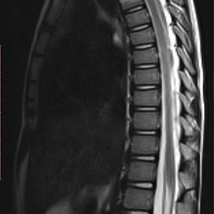 МРТ грудного отдела позвоночника в СПб: показания, правила подготовки, результаты