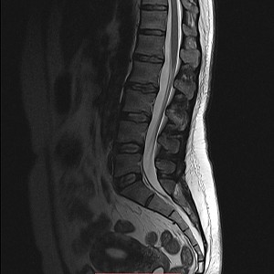 МРТ пояснично-крестцового отдела позвоночника: что показывает, как проводиться и кому противопоказано
