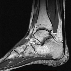 МРТ голеностопного сустава: преимущества, ход процедуры и противопоказания