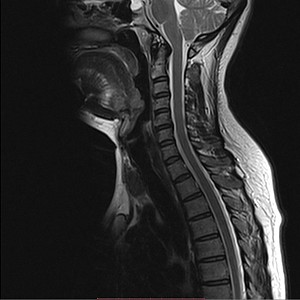 МРТ шейного отдела позвоночника: показания, преимущества и особенности выполнения