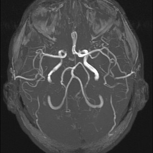 МРТ сосудов головного мозга: характеристики, особенности и преимущества