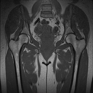 МРТ тазобедренного сустава: показания, особенности и результаты